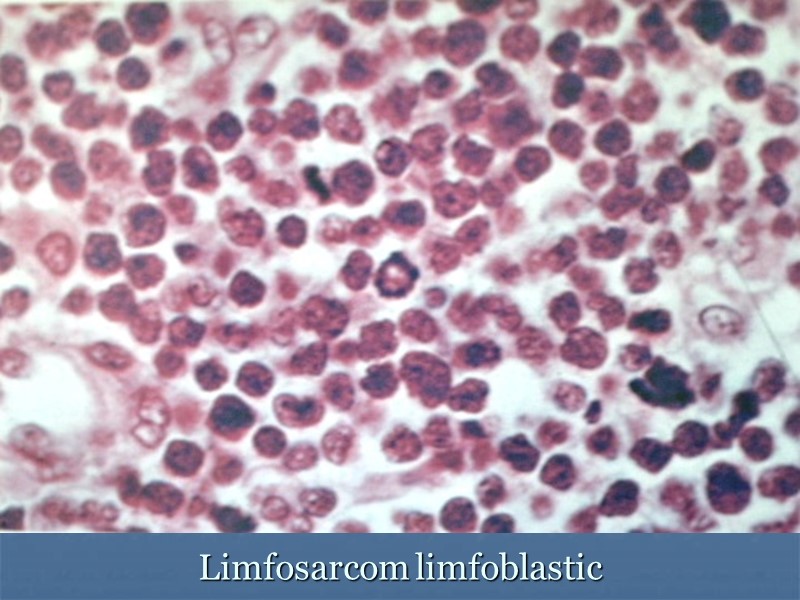 Limfosarcom limfoblastic